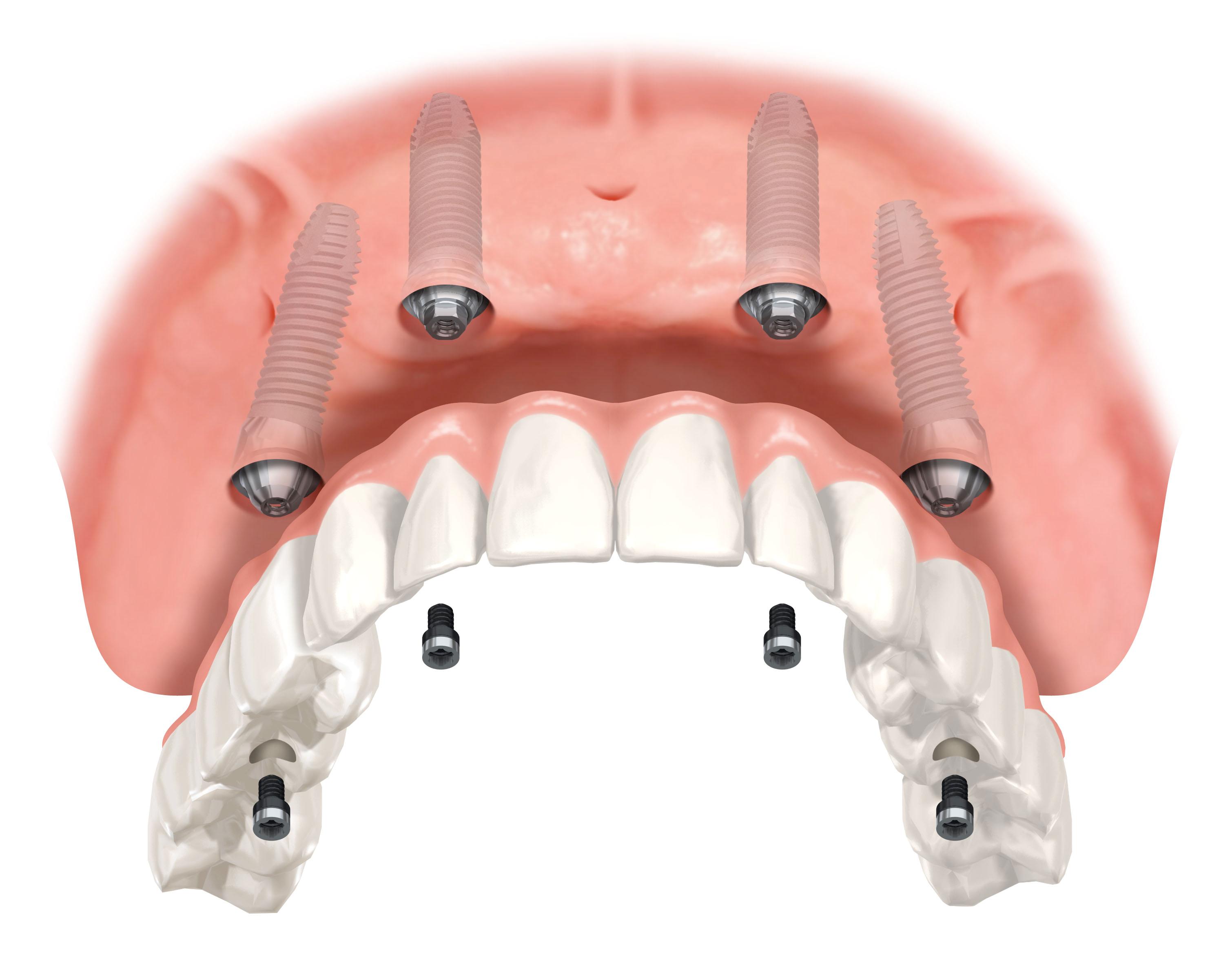 All on 4 Top Arch Dental Implants White Bear Lake MN